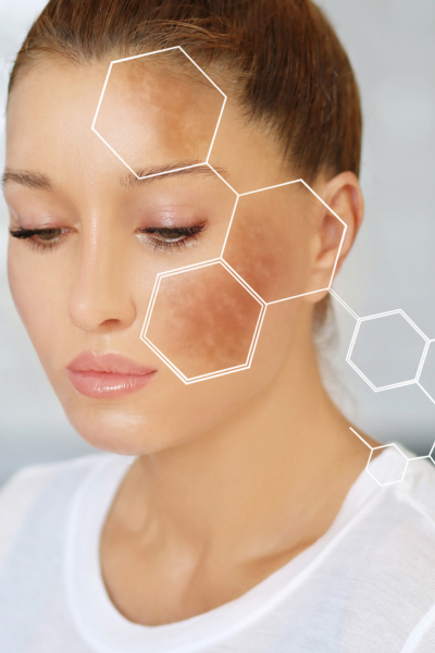 Pigmentation Treatment Sandton Johannesburg near me 2