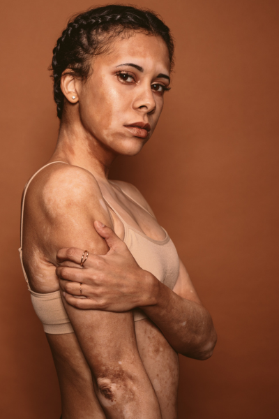 woman with pigmentation problem