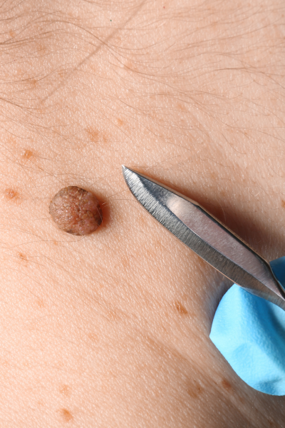Skin Tag Removal Sandton Johannesburg near me 1