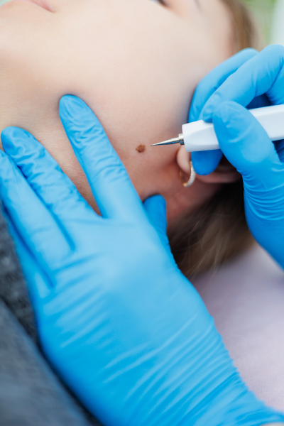 expert of derma laser clinic providing skin tag removal treatment on face