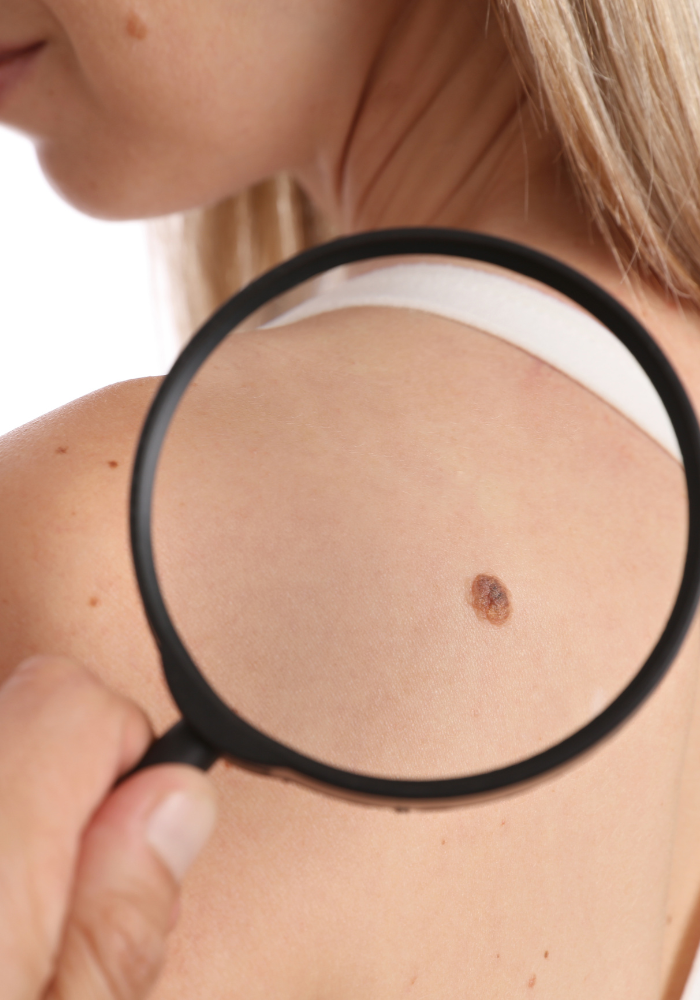 Skin tag Removal in Sandton