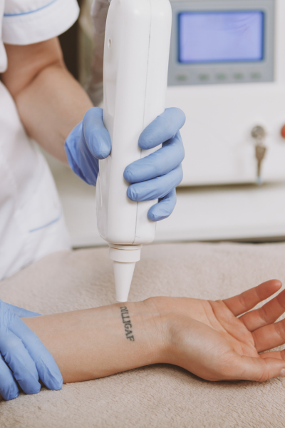 removing tattoo from the wrist of a client of derma laser clinic