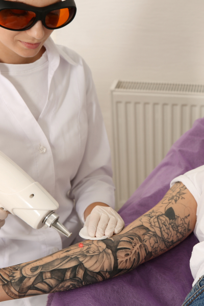 a tattoo removal specialist from derma laser clinic providing tattoo removal service on her clients hand